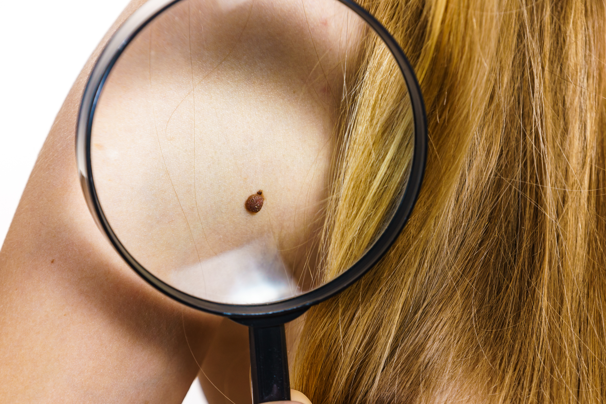 Kaj je kožni rak melanom in kako ga prepoznamo?